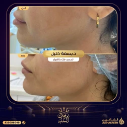 <p>حالة تحديد فك بالفيلر&nbsp;</p>