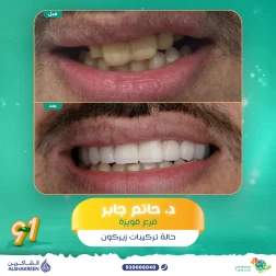 <p>حالة تركيبات زيركون&nbsp;</p>