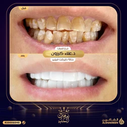<p>حالة دايركت فينير&nbsp;</p>
