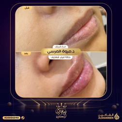 <p>حالة فيلر شفايف&nbsp;</p>