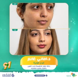 <p>حالة علاج الخفسة تحت العين بالفيلر&nbsp;<br />
وفيلر شفايف&nbsp;</p>