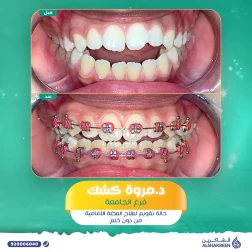 <p>حالة تقويم لعلاج العضة الأمامية من دون خلع&nbsp;</p>